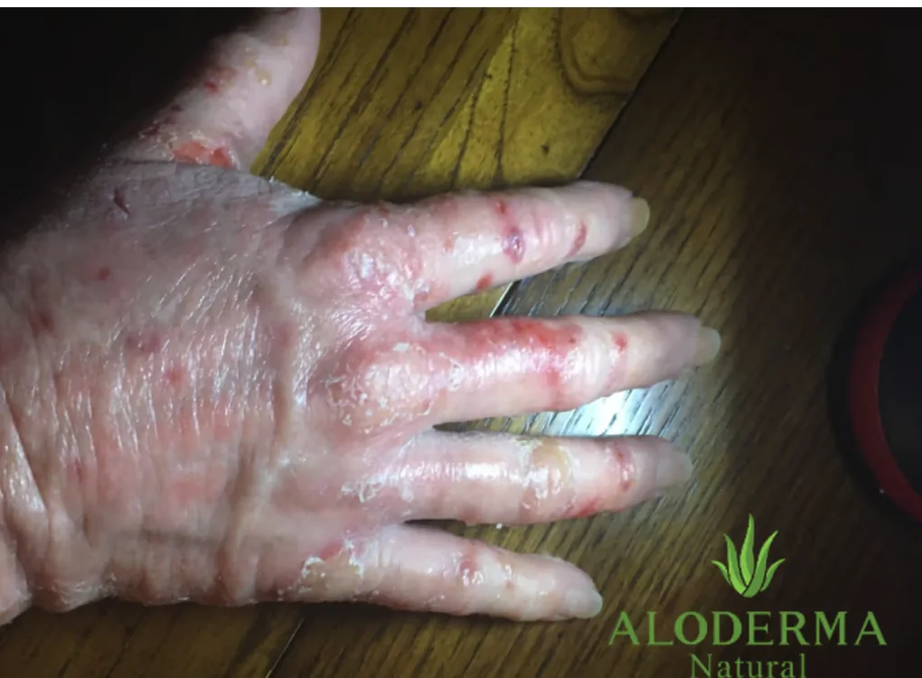 Customer's hand before using ALODERMA pure gel