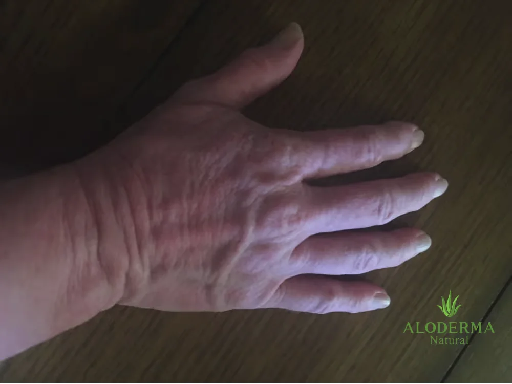 The same hand after using ALODERMA pure gel